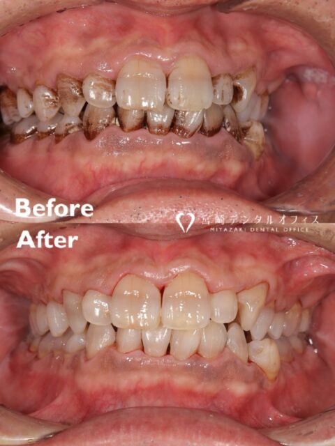 【エアフロー】

コーヒー好きな方で着色のご相談を受けました☕️
今回は2回目のエアフローです🪥

エアフローとは歯のクリーニングで用いる機器です✨
ジェット水流を用いて、微粒子パウダーを歯面や器具の届かない隙間にまで吹き付けることができ、タバコのヤニなどの着色やプラークなどのバイオフィルムを隅々まできれいに効果的に除去します🦷🪄
低侵襲なことも特徴です。 
保険適用のクリーニングでは、歯面についた歯石を手用や超音波タイプの「スケーラー」という器具を使って取り除いていきます。
その主な目的は虫歯や歯周病の原因となる細菌の除去であり、主に治療の一環として行われます。 
エアフローによるクリーニングは、審美や予防に重点が置かれ、今よりも良好で快適な口腔環境のために行います。
エアフローで除去の対象となるのは茶渋🍵・ヤニ🚬などの着色汚れや、歯磨きでは落とせないバイオフィルム（プラーク）🦠です。

定期的なクリーニングを行い、口腔環境の改善に努めましょう🧚🏻‍♀️

#宮崎デンタルオフィス #愛媛県 #愛媛松山市 #松山市 #松山市歯医者 #松山歯医者 #歯科医院 #歯科医師 #虫歯 #歯周病 #親知らず #ホワイトニング #セラミック #ボツリヌス治療 #ボトックス #マイクロスコープ #ダイレクトボンディング #ラバーダム #審美治療 #エアフロー #icon #アイコン #ホワイトスポット #インビサライン #インビザラインgo #精密根管治療 #ウォーキングブリーチ#高濃度ビタミンc点滴 #歯のクリーニング #歯の黄ばみ