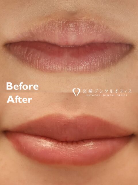 【デンタルアートメイク】
半年程前から当院の患者様やご紹介をメインにリップアートメイクを導入致しました💄
ご来院された際にご提案すると、唇の血色が悪く悩まれている方は結構多くて👄
施術を受けていただいた患者様には喜んで頂けています💞

口腔内からのブロック麻酔と表面麻酔を併用して疼痛コントロールを行うので、アートメイクは気になっていたが痛みに弱く勇気が出なかったという方にも好評です😖✨

リップアート導入によりモニターを募集中です🫶🏻
webに症例掲載可能な方、リタッチの日程が調整可能な方に限りモニター価格にてご案内しております💋
詳細はInstagram(@miyazakidentaloffice)のDMまたはお電話にてお問い合わせください🙇🏻‍♀️

#アートメイク#宮崎デンタルオフィス #愛媛県 ＃愛媛松山市 ＃松山市#南梅本町 ＃松山市歯医者 #松山歯医者 ＃歯科医院 ＃歯科医師虫歯歯周病＃親知らず＃ホワイトニングセラミック ＃ボツリヌス治療＃ボトックスマイクロスコープ＃＃ダイレクトボンディング ＃ラバーダム ＃審美治療＃エアフロー＃icon ＃アイコン＃ホワイトスポット ＃インビサライン＃インビザラインgo ＃精密根管治療＃ウォーキングブリーチ