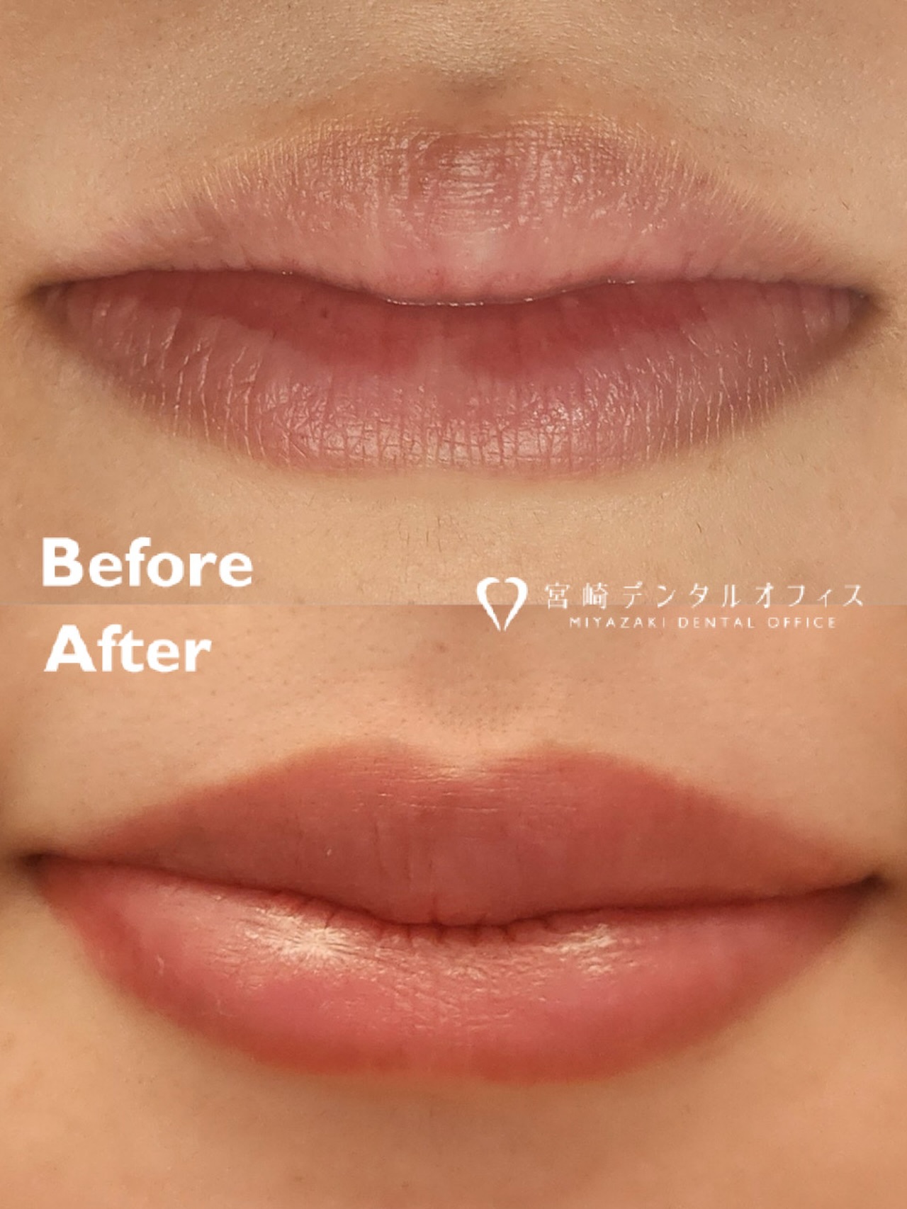 【デンタルアートメイク】
半年程前から当院の患者様やご紹介をメインにリップアートメイクを導入致しました💄
ご来院された際にご提案すると、唇の血色が悪く悩まれている方は結構多くて👄
施術を受けていただいた患者様には喜んで頂けています💞

口腔内からのブロック麻酔と表面麻酔を併用して疼痛コントロールを行うので、アートメイクは気になっていたが痛みに弱く勇気が出なかったという方にも好評です😖✨

リップアート導入によりモニターを募集中です🫶🏻
webに症例掲載可能な方、リタッチの日程が調整可能な方に限りモニター価格にてご案内しております💋
詳細はInstagram(@miyazakidentaloffice)のDMまたはお電話にてお問い合わせください🙇🏻‍♀️

#アートメイク#宮崎デンタルオフィス #愛媛県 ＃愛媛松山市 ＃松山市#南梅本町 ＃松山市歯医者 #松山歯医者 ＃歯科医院 ＃歯科医師虫歯歯周病＃親知らず＃ホワイトニングセラミック ＃ボツリヌス治療＃ボトックスマイクロスコープ＃＃ダイレクトボンディング ＃ラバーダム ＃審美治療＃エアフロー＃icon ＃アイコン＃ホワイトスポット ＃インビサライン＃インビザラインgo ＃精密根管治療＃ウォーキングブリーチ