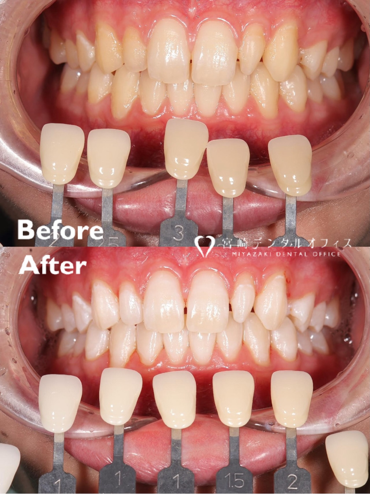 【オフィスホワイトニング】
ホワイトニングには、歯科医院にて、歯科医師・歯科衛生土管理の下、高濃度の薬液・レーザー（光触媒）を用いて行うオフィスホワイトニングと専用のマウスピースを作成後、ご自身で薬液を用いて自宅にて行うホームホワイトニングがあります🌷
どちらの方法も効果が高いですが、これらを併用するデュアルホワイトニングも特にオススメです！
この患者様は、Instagramを見てホワイトニングをご希望され当院に来院されました。
カウンセリングを行い、副院長が担当させていただきました👩🏻‍⚕️
一度の施術でとてもご満足いただきました✨

時間経過とともに後戻りの可能性がございますので、患者様のライフスタイルに合わせてホームホワイトニングをの併用を推奨しております🌈

ご興味のある方は気軽に是非ご相談くださいませ♥
#ホワイトニング#松山ホワイトニング #歯のホワイトニング #オフィスホワイトニング #愛媛ホワイトニング