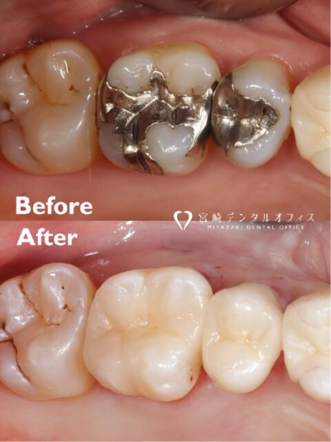 【オールセラミック修復治療】

"強く噛むとたまに沁みる、だんだんと違和感が強くなってきた。昔行った治療なので、悪くなってきているところはしっかりとした治療を受けたい"というご相談で、来院された患者様です🙌🏻

矯正治療の既往もあり、口腔内の清掃状況はすごく良くコントロールされていました👏🏻✨

しかし、噛み合わせ・食いしばりが強く、歯にクラック(いわゆるひび割れ)が多数認められ、二次的な虫歯も散見されました🫨

保険診療で用いる銀歯(合金)は、
・天然歯と比較し固すぎる
・材質としての予後の限界(治療後問題なく長期的に維持されるか)
・歯の便宜的な切削量が多い

など、多くのデメリットがあります。
できるだけ再治療を避けたい・歯の健康寿命を延伸したい等の希望もあり、保険診療、保険外診療(自費診療)についてしっかりとご説明させていただいたところ、保険外診療での加療をご希望されました。

複数歯にまたがるトラブルを認めましたが、保険外診療である為、患者様のご希望も治療計画に考慮させていただき、来院回数2回で終了致しました。

精度の高い仕上がりに大変ご満足いただきまして、嬉しく思っております🙇🏻‍♂️
今後も要治療歯が残存しておりますので、しっかりと治療にあたっていくとともに経過も追っていきます👨🏻‍⚕️

#セラミック治療 #メタルフリー #オールセラミック #松山歯医者 #銀歯