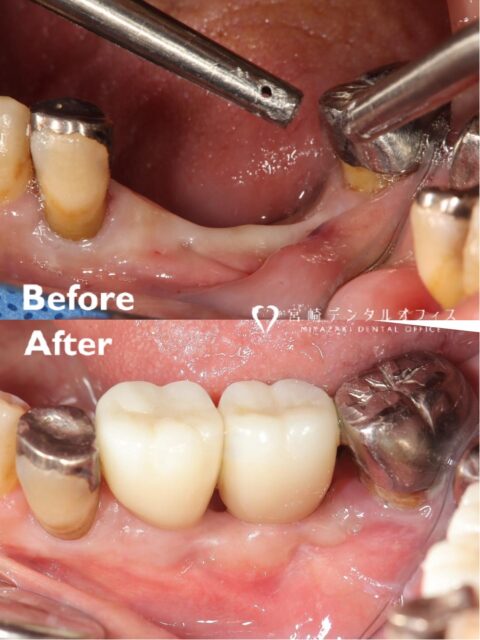 【骨造成・インプラント補綴治療】

右下奥歯で噛むと違和感、痛みで噛めないとの主訴で来院された患者様です🙌🏻

診査・診断の結果、右下奥歯は歯根破折をきたしており、保存困難な状況でした。
当時のかかりつけ医より、抜歯を行い、部分入れ歯の提案がされておりましたが、固定性の歯で長くしっかりと噛めるようにしたいとの希望が強く、抜歯・骨造成手術を伴ったインプラント補綴をご希望されました🦷

初診時、歯根破折をきたし、長期にわたり限界を超えていた歯の周りの骨（歯槽骨）は重度の感染（骨吸収）をおこしてしまっている状況でした👾
患者様には、抜歯後の骨吸収、骨造成の必要性をご説明させていただき、同意をいただきましたので、しっかりと治療に望むことができました👨🏻‍⚕️

抜歯、骨造成手術、インプラント埋入手術を行い、ご希望であった固定性の補綴治療を終えることができ、大変満足いただくことができました🙇🏻‍♂️

他にも要処置歯はありますが、今後も口腔寿命延伸の為、しっかりと治療を行っていきたいと思います💪🏻

骨造成手術を併用することで、他院では困難と提案を受けている部位のインプラント補綴治療も、状態によっては可能となる場合もございまお困りの際は、お気軽にまずはご相談ください✨

#インプラント ＃骨造成#松山歯医者＃宮崎デンタルオフィス#マイクロスコープ