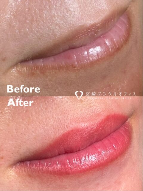 【リップアートメイク】
上唇、下唇ともに茶くすみが強く、内側の血色が薄い方👄
しっかりとした色味をご希望されておりました💄
明るく華やかな雰囲気に🔆
術中は高濃度ビタミンC点滴も行いました🍋

口腔内からのブロック麻酔と表面麻酔を併用して疼痛コントロールを行うので、アートメイクは気になっていたが痛みに弱く勇気が出なかったという方にも好評です😖✨

webに症例掲載可能な方、リタッチの日程が調整可能な方に限りモニター価格にてご案内しております💋
詳細はInstagram(@miyazakidentaloffice)のDMまたはお電話にてお問い合わせください🙇🏻

#アートメイク #リップアートメイク #高濃度ビタミンC点滴 #愛媛 #松山歯医者 

【リップアートメイク】
施術前→1回目定着→2回目✨

webに症例掲載可能な方、リタッチの日程が調整可能な方に限りモニター価格にてご案内しております💋
詳細はInstagram(@miyazakidentaloffice)のDMまたはお電話にてお問い合わせください🙇🏻

#アートメイク #リップアートメイク #高濃度ビタミンc点滴 #愛媛 #松山歯医者

【リップアートメイク】
2回目終了時🎥
iPhoneカメラ、チェアのライトのみです☺️

webに症例掲載可能な方、リタッチの日程が調整可能な方に限りモニター価格にてご案内しております💋
詳細はInstagram(@miyazakidentaloffice)のDMまたはお電話にてお問い合わせください🙇🏻

#アートメイク #リップアートメイク #高濃度ビタミンc点滴 #愛媛 #松山歯医者